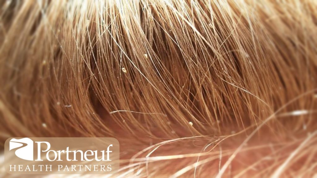 2. The Best Nit Detection Methods for Blonde Hair - wide 6