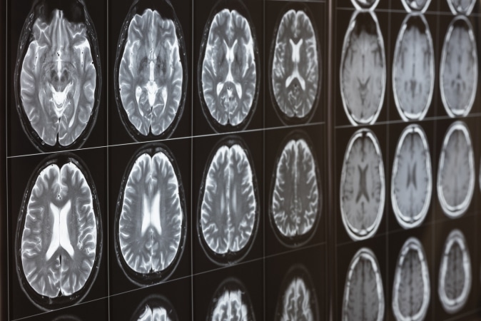 brain xrays